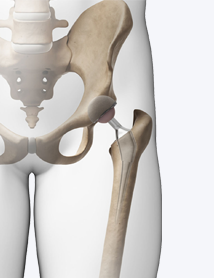 hip-replacement-in-delhi