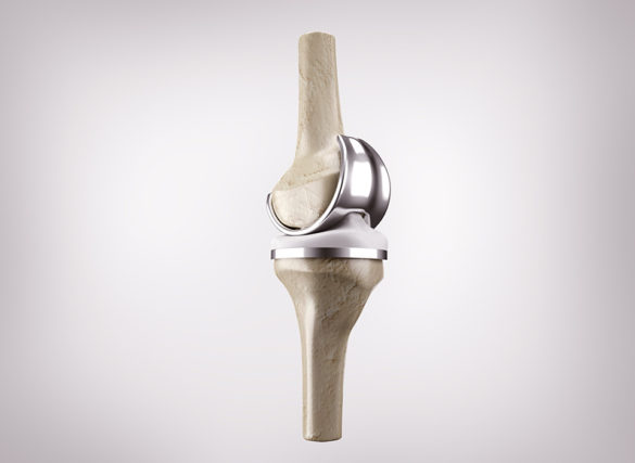 knee-replacement-faq