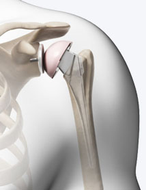 shoulder-replacement-surgery-delhi